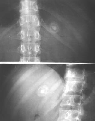 胆囊结石X光片[图]